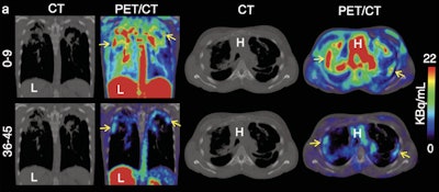 Representative coronal (left) and transverse (right) CT and 11C-PABA PET/CT images from a 33-year-old female with cystic fibrosis and confirmed M. abscessus infection in a 45-minute dynamic PET scan after an intravenous injection of 518 MBq of 11C-PABA. In the first nine minutes of the scan 11C-PABA got distributed systemically, followed by rapid clearance via heptic and renal excretion, showing accumulation of 11C-PABA only inside the affected lesion in the last 10 minutes. Not all lesions visualized on CT were PET avid, suggesting that some lesions may be sterile or had very low bacterial burden. The y axis shows time in minutes.