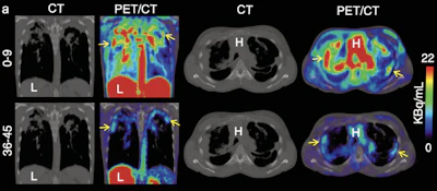 Representative coronal (left) and transverse (right) CT and 11C-PABA PET/CT images from a 33-year-old female with cystic fibrosis and confirmed M. abscessus infection in a 45-minute dynamic PET scan after an intravenous injection of 518 MBq of 11C-PABA. In the first nine minutes of the scan 11C-PABA got distributed systemically, followed by rapid clearance via heptic and renal excretion, showing accumulation of 11C-PABA only inside the affected lesion in the last 10 minutes. Not all lesions visualized on CT were PET avid, suggesting that some lesions may be sterile or had very low bacterial burden. The y axis shows time in minutes.