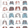 Examples of predicted dense emphysema binary masks for subjects with different GOLD scores. The top three rows show the predicted regions of centrilobular emphysema, and the bottom three rows show the predicted regions of paraseptal emphysema.