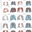 Examples of predicted dense emphysema binary masks for subjects with different GOLD scores. The top three rows show the predicted regions of centrilobular emphysema, and the bottom three rows show the predicted regions of paraseptal emphysema.