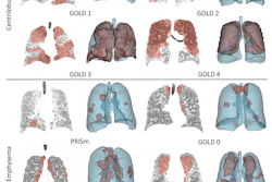 Examples of predicted dense emphysema binary masks for subjects with different GOLD scores. The top three rows show the predicted regions of centrilobular emphysema, and the bottom three rows show the predicted regions of paraseptal emphysema.
