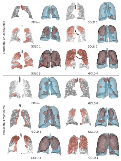Examples of predicted dense emphysema binary masks for subjects with different GOLD scores. The top three rows show the predicted regions of centrilobular emphysema, and the bottom three rows show the predicted regions of paraseptal emphysema.