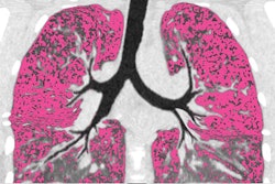 Air trapping (colored pink) in lungs of a cystic fibrosis patient before CFTR modulator treatment.