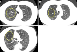 Representative axial images of mild, moderate and severe emphysema at baseline low-dose CT.
