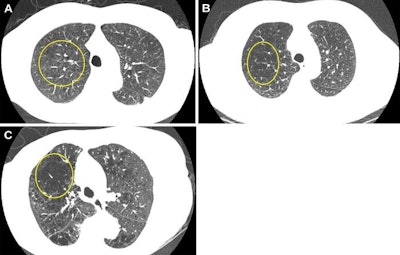 Representative axial images of mild, moderate, and severe emphysema at baseline low-dose CT (LDCT).