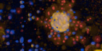 Genetically modified immune cells (CAR-T cells, blue) specifically attack 3D tumor tissue (tumoroids, yellow) and kill tumor cells (visible as dead cells marked in red).