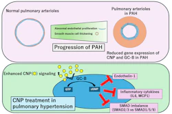 Proposed role of CNP/GC-B signaling in PAH. In PAH, expression of CNP and its receptor GC-B is reduced in the pulmonary vasculature. Endothelial cell-specific CNP or GC-B knockout mice, but not smooth muscle cell-specific GC-B knockout mice, showed more severe PH in mice. Administration of CNP activates endothelial GC-B signaling, which suppresses endothelin-1, inflammatory cytokines and SMAD imbalance, thereby attenuating pulmonary vascular remodeling and disease progression.