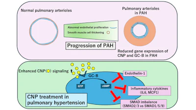 Proposed role of CNP/GC-B signaling in PAH. In PAH, expression of CNP and its receptor GC-B is reduced in the pulmonary vasculature. Endothelial cell-specific CNP or GC-B knockout mice, but not smooth muscle cell-specific GC-B knockout mice, showed more severe PH in mice. Administration of CNP activates endothelial GC-B signaling, which suppresses endothelin-1, inflammatory cytokines and SMAD imbalance, thereby attenuating pulmonary vascular remodeling and disease progression.
