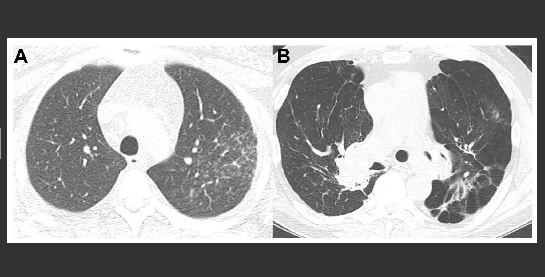 A. Nonfibrotic sarcoidosis; B. Fibrotic sarcoidosis