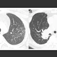 A. Nonfibrotic sarcoidosis; B. Fibrotic sarcoidosis