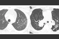 A. Nonfibrotic sarcoidosis; B. Fibrotic sarcoidosis