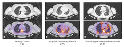Sample images from each participant group. A: CT only; B: fused SPECT-CT 99mTc-maraciclatide
