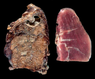 Gross pathology comparison of a healthy human lung (right) and a lung with advanced silicosis (left).