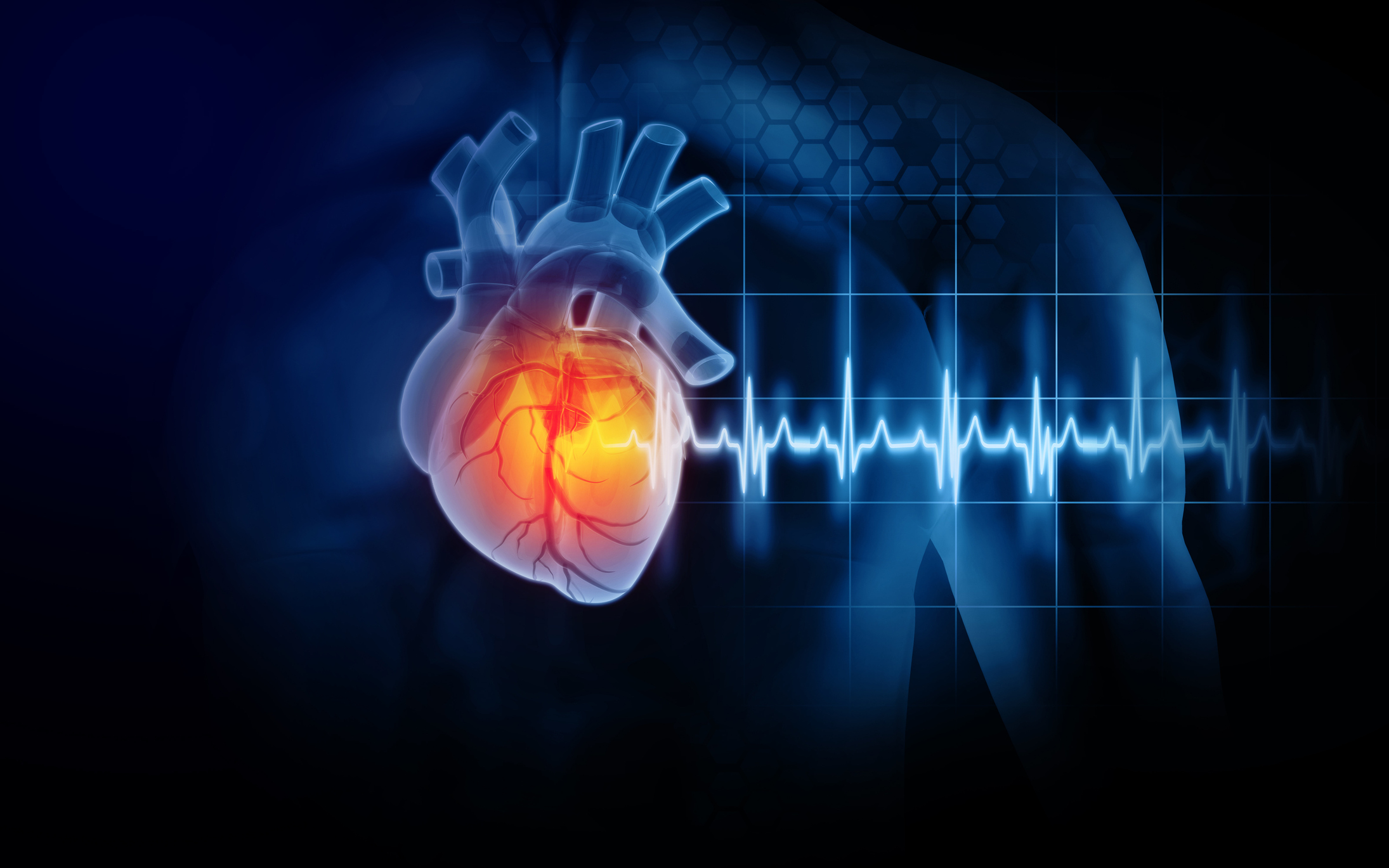 Myocardial Infarction