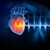Myocardial Infarction