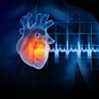 Myocardial Infarction