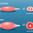 Sarcopenia2
