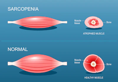 Sarcopenia2