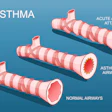 Comparison of normal airways, asthmatic airways, and acute asthma attack showing progressive airway constriction and inflammation