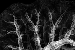 This sample shows muscle wrapped around airway and blood vessel structures close to the outer surface of the fetal lung, which eventually forces the adult heart to work harder in order to properly pump blood.