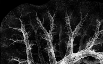 This sample shows muscle wrapped around airway and blood vessel structures close to the outer surface of the fetal lung, which eventually forces the adult heart to work harder in order to properly pump blood.