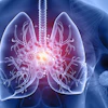 3D medical illustration of lungs showing inflammation and disease with glowing viral particles and branching airways