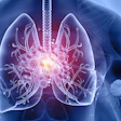 3D medical illustration of lungs showing inflammation and disease with glowing viral particles and branching airways