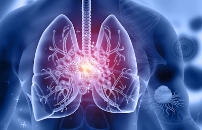 3D medical illustration of lungs showing inflammation and disease with glowing viral particles and branching airways