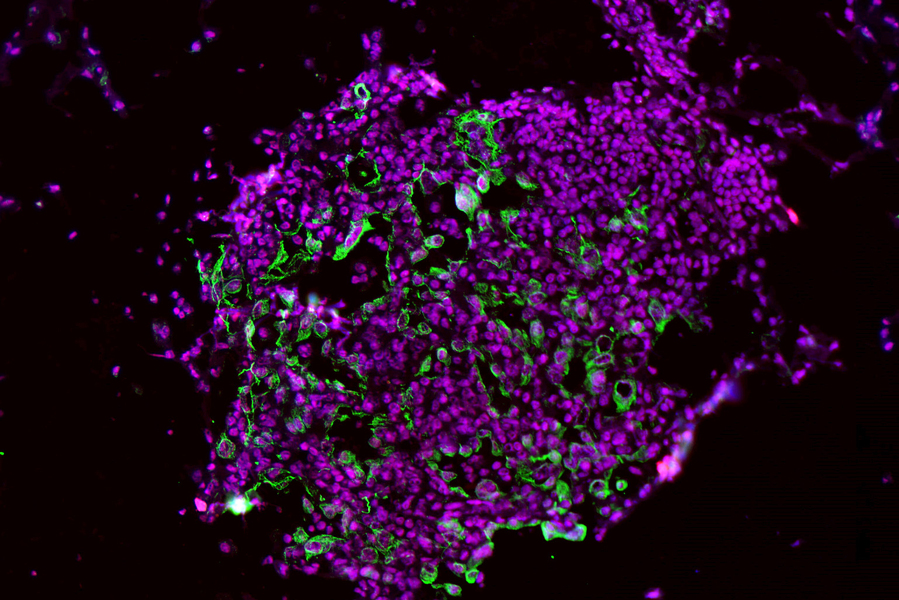 These early-development lung tumor cells show high levels of the enzyme caspase-1 (green and red stains).