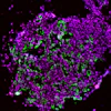 These early-development lung tumor cells show high levels of the enzyme caspase-1 (green and red stains).