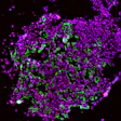 These early-development lung tumor cells show high levels of the enzyme caspase-1 (green and red stains).