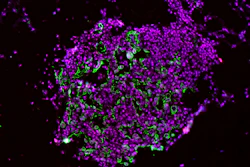 These early-development lung tumor cells show high levels of the enzyme caspase-1 (green and red stains).