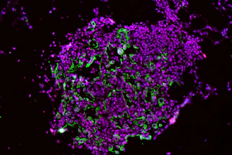 These early-development lung tumor cells show high levels of the enzyme caspase-1 (green and red stains).