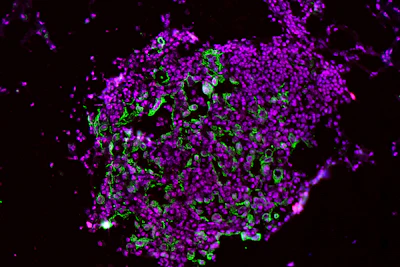 These early-development lung tumor cells show high levels of the enzyme caspase-1 (green and red stains).