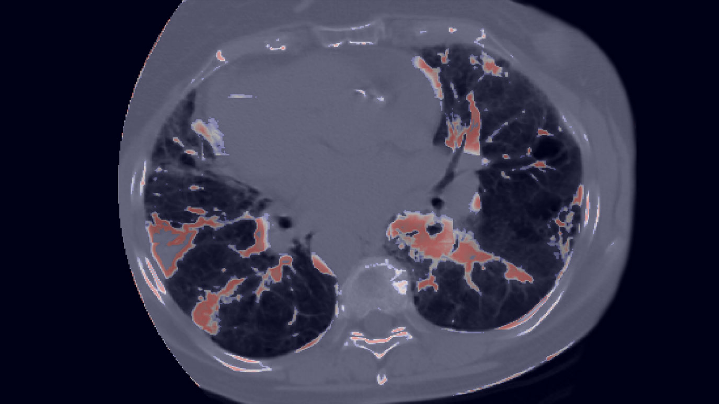 Axial CT scan of chest showing lungs with contrast-enhanced vascular structures highlighted in orange