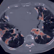 Axial CT scan of chest showing lungs with contrast-enhanced vascular structures highlighted in orange