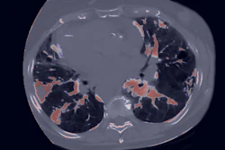 Axial CT scan of chest showing lungs with contrast-enhanced vascular structures highlighted in orange