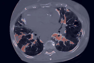 Axial CT scan of chest showing lungs with contrast-enhanced vascular structures highlighted in orange