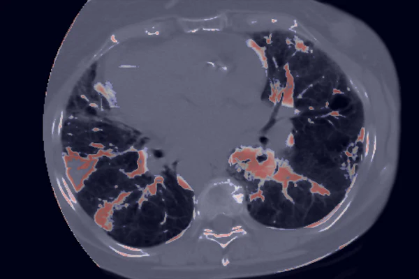 Axial CT scan of chest showing lungs with contrast-enhanced vascular structures highlighted in orange