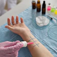 Allergy skin prick test being performed on patient's arm with testing vials and materials visible