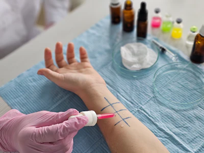 Allergy skin prick test being performed on patient's arm with testing vials and materials visible
