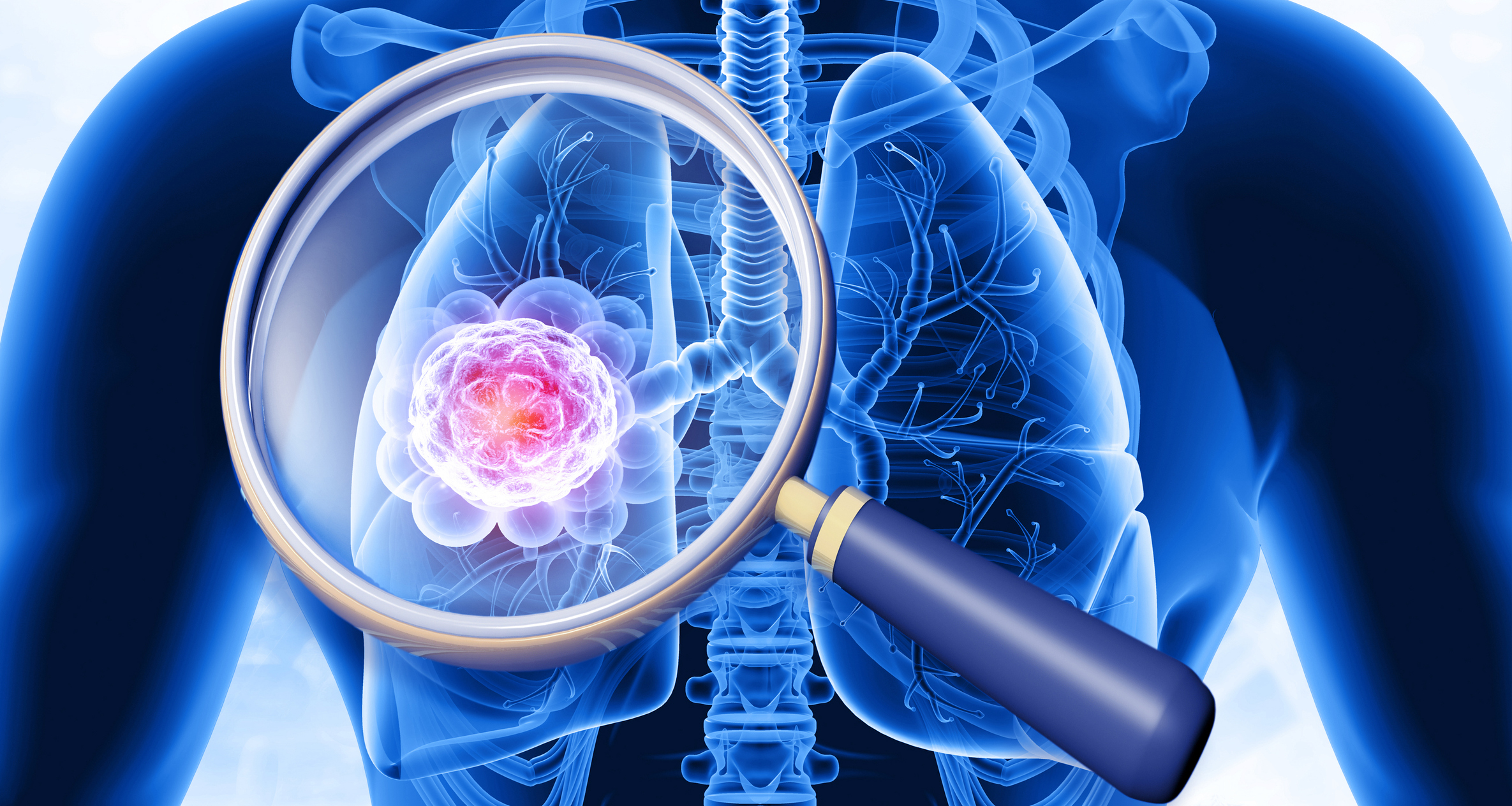 3D medical illustration of human lungs with magnified view of pink cancer cells highlighted through magnifying glass