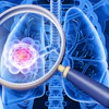 3D medical illustration of human lungs with magnified view of pink cancer cells highlighted through magnifying glass