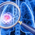 3D medical illustration of human lungs with magnified view of pink cancer cells highlighted through magnifying glass