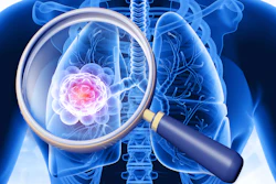 3D medical illustration of human lungs with magnified view of pink cancer cells highlighted through magnifying glass