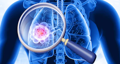 3D medical illustration of human lungs with magnified view of pink cancer cells highlighted through magnifying glass